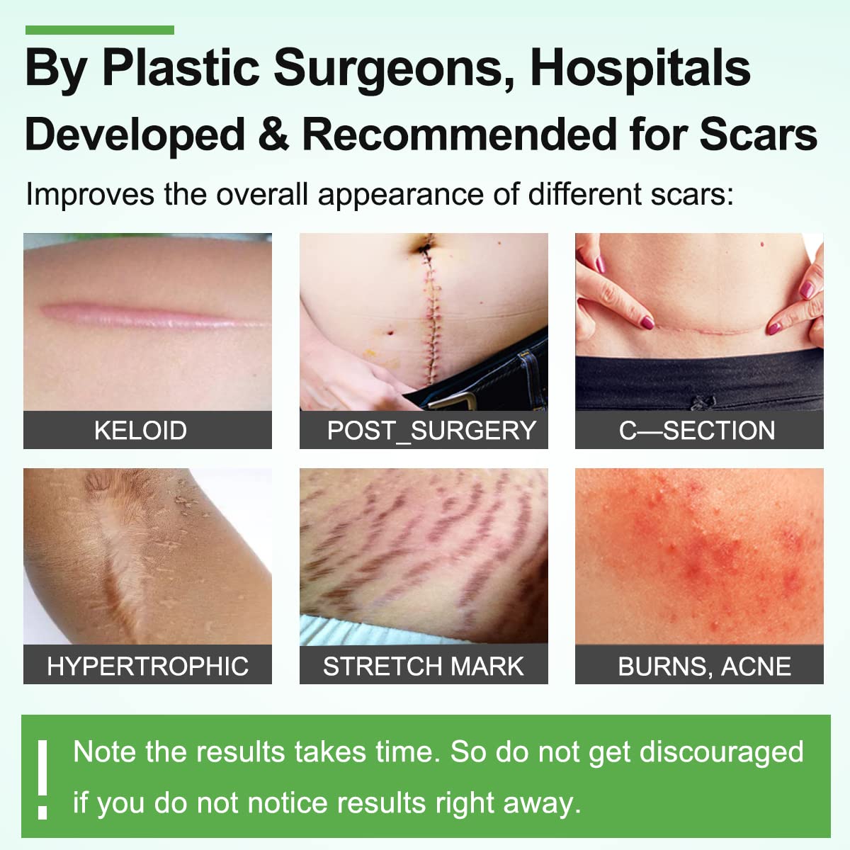 Medical Grade Silicone Therapy for Skin Healing

