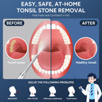 Tonsil Stone Remover with Camera - 1080P Visual Kit

