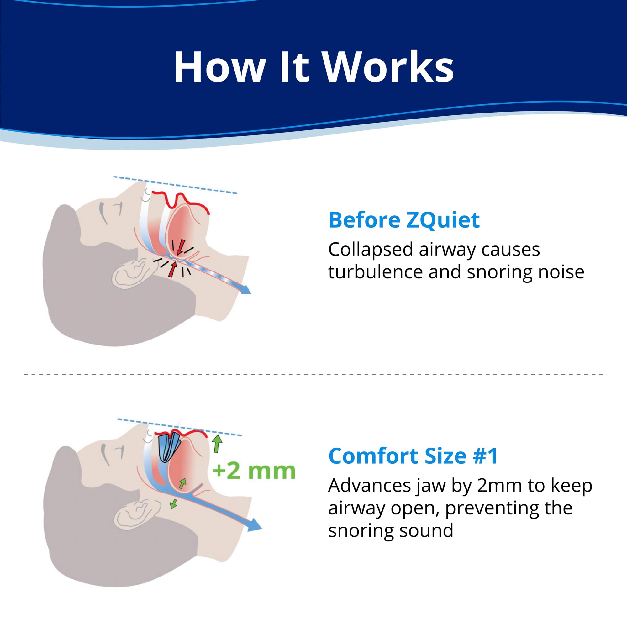 ZQuiet Anti-Snoring Mouthpiece | OTC BPA-Free

