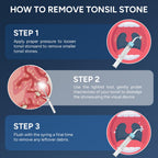 Tonsil Stone Remover with Camera - 1080P Visual Kit


