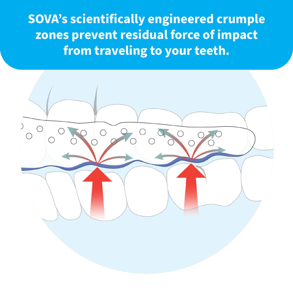 SOVA Aero Night Guard with Case | Teeth Grinding Protection

