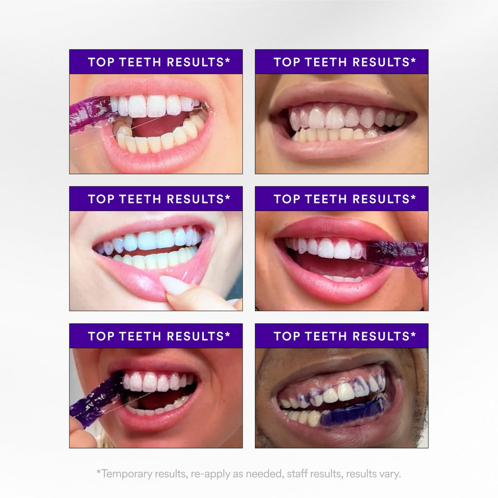 Hismile V34 Teeth Whitening Strips | Colour Correction


