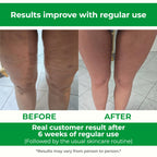 TESMED Cellulite Manual Massager - Patented Roller System

