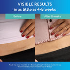 ScarAway Advanced Clear Silicone Scar Sheets | Medical Grade

