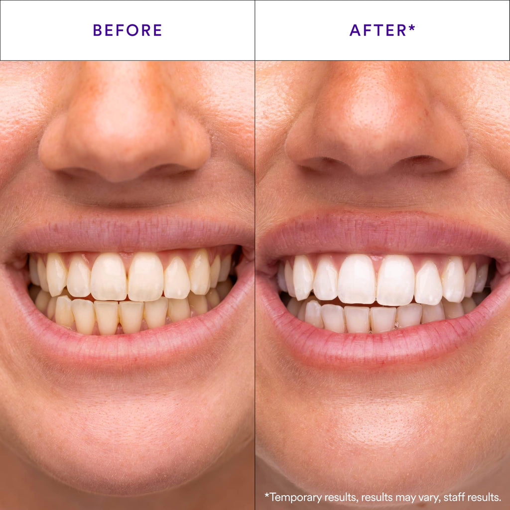 Hismile V34 Teeth Whitening Strips | Colour Correction

