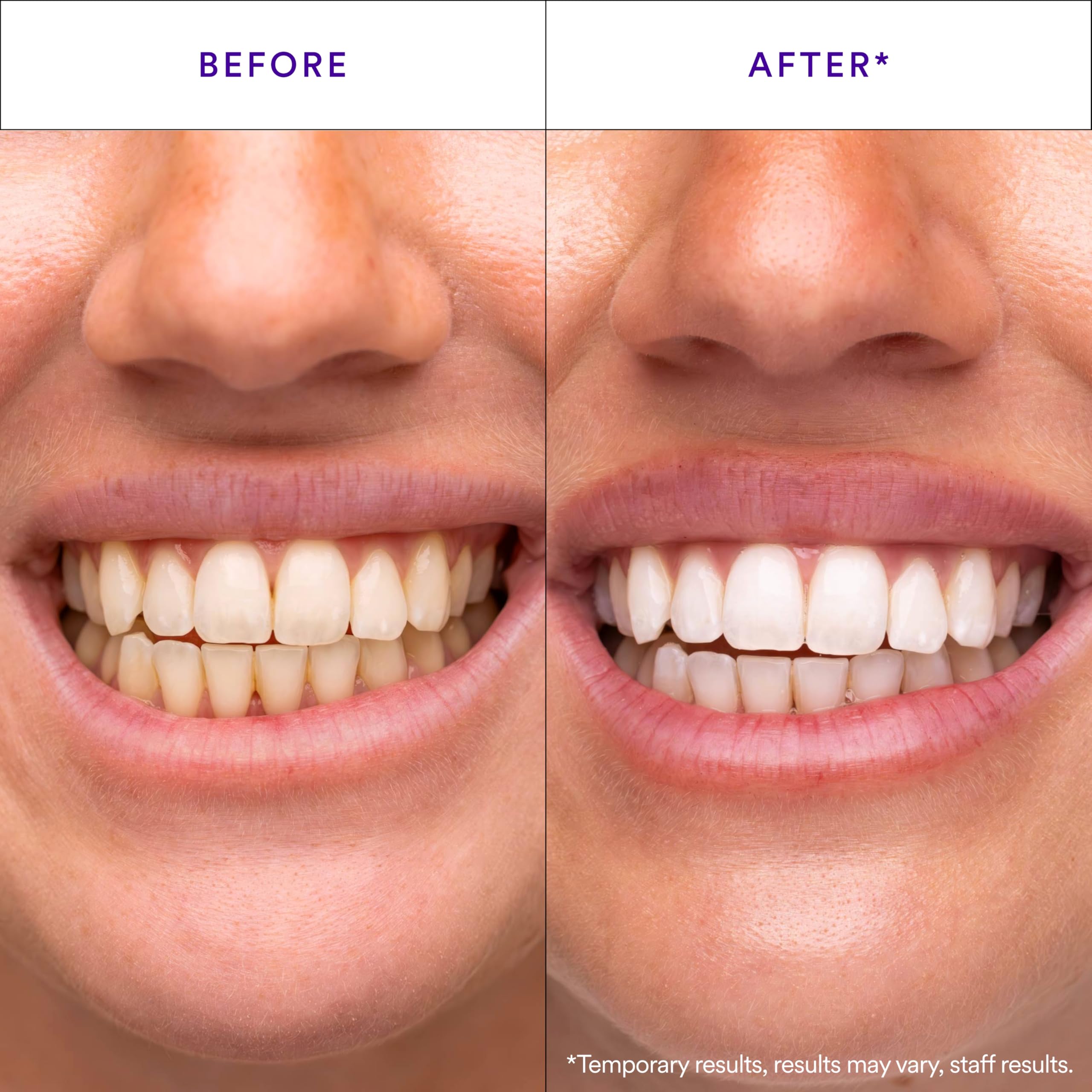 Hismile V34 Teeth Whitening Strips | Colour Correction

