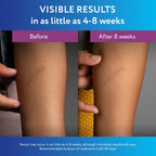 ScarAway Silicone Scar Gel for Hypertrophic & Keloid Scars

