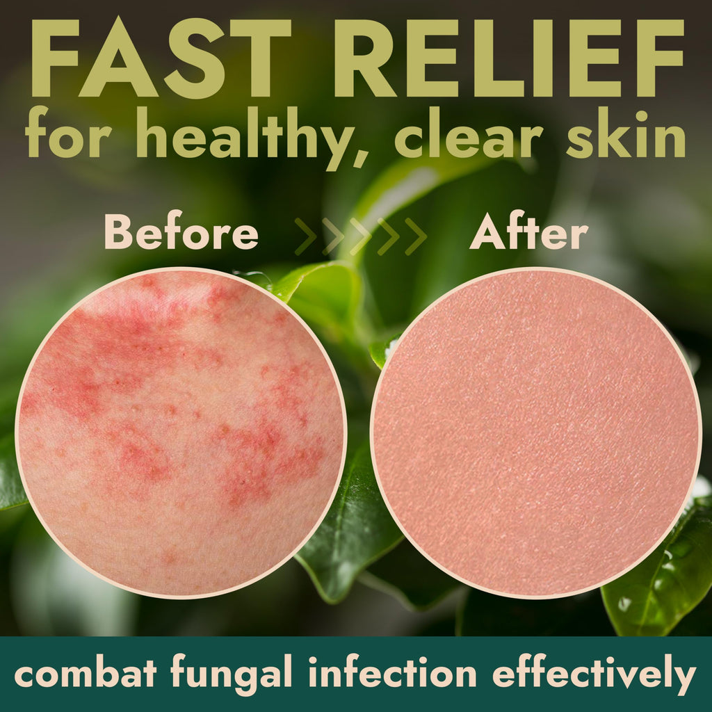 Tea Tree Oil Antifungal Treatment | Skin Infections

