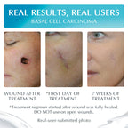 MyNewGel Silicone Scar Gel with Vitamin E - Scar Care

