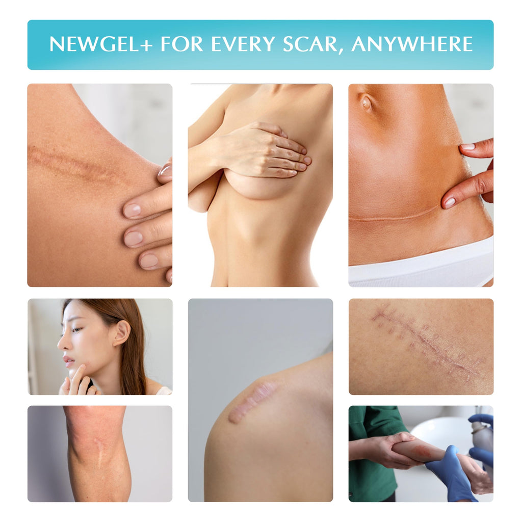 MyNewGel Silicone Scar Gel with Vitamin E - Scar Care

