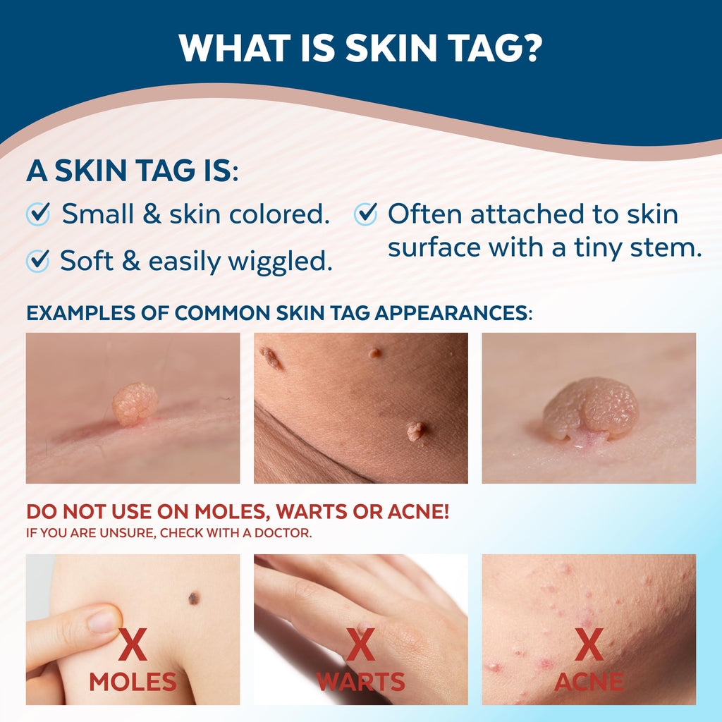 Claritag Skin Tag Remover - At-Home Use

