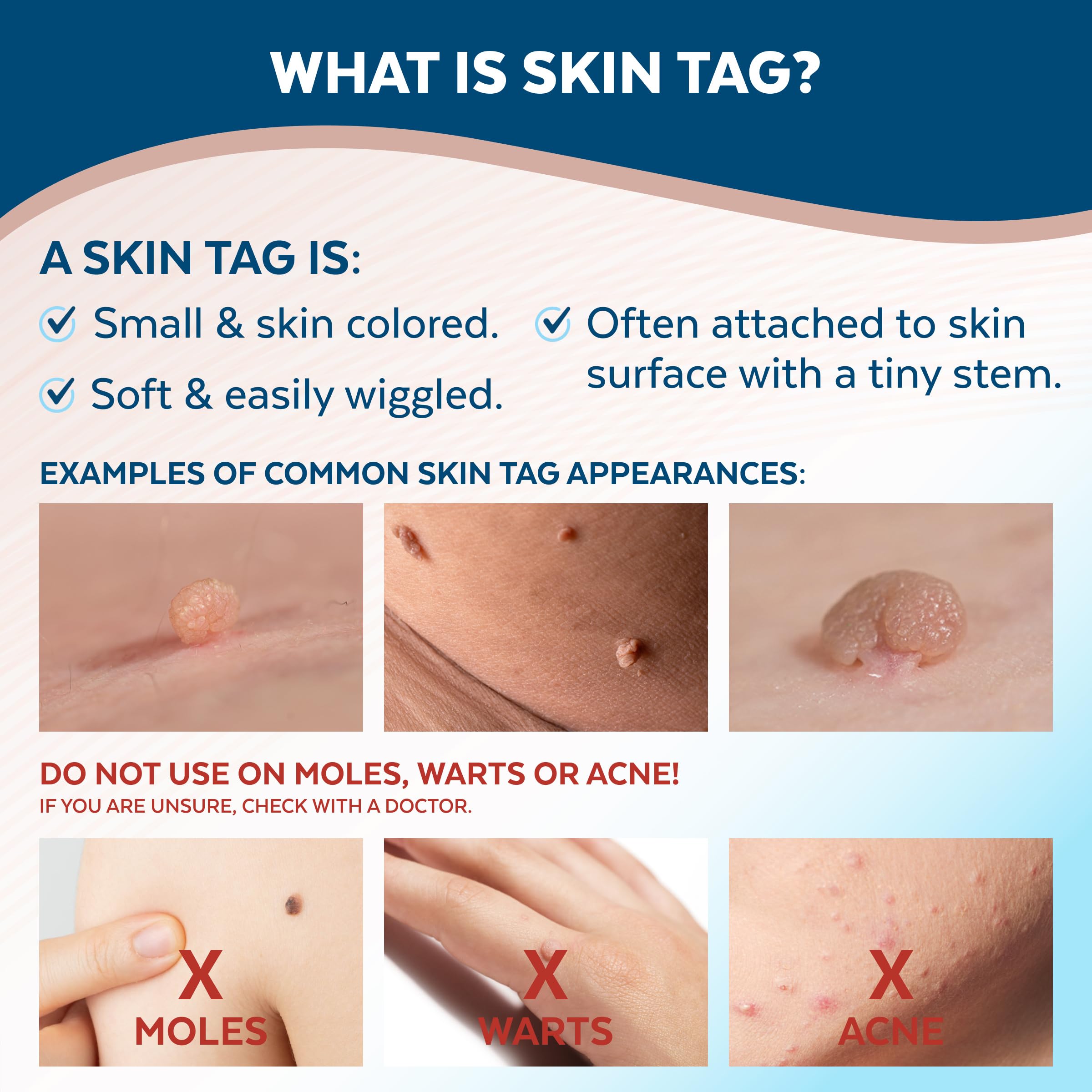 Claritag Skin Tag Remover - At-Home Use

