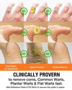 Samsali Wart and Corn Remover for Feet | Salicylic Acid Treatment

