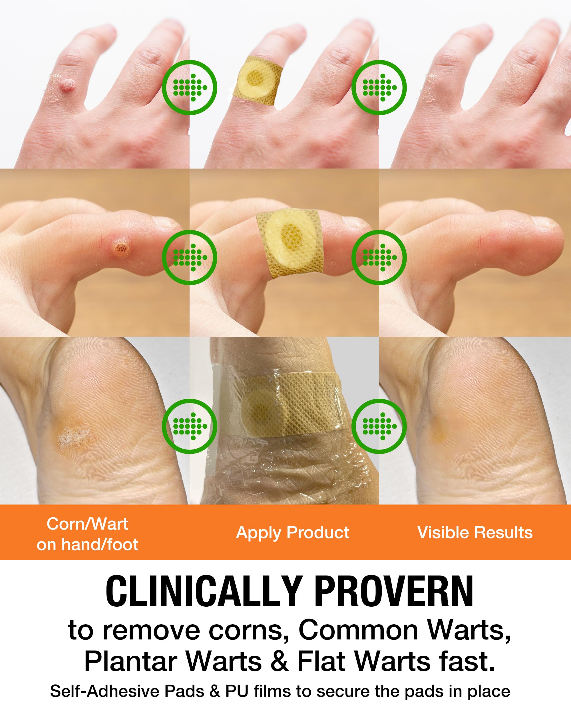 Samsali Wart and Corn Remover for Feet | Salicylic Acid Treatment

