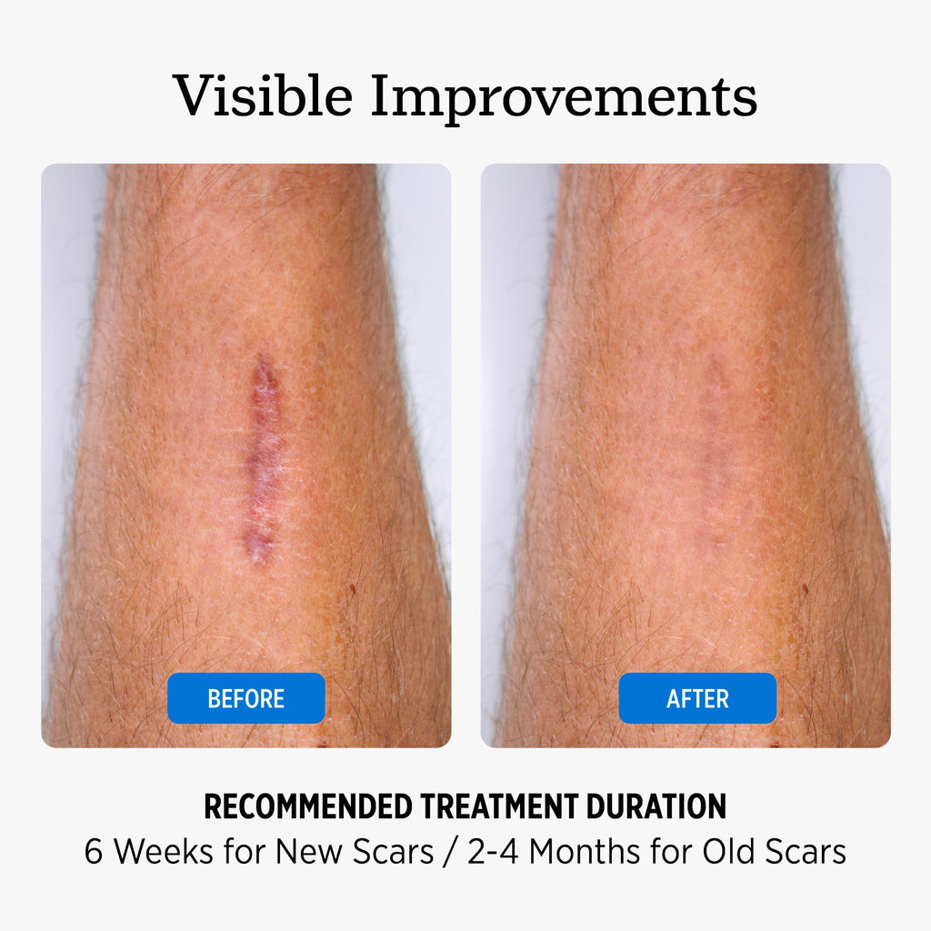 NUVADERMIS Silicone Scar Sheets for Surgical Scars

