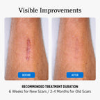 NUVADERMIS Silicone Scar Sheets for Surgical Scars

