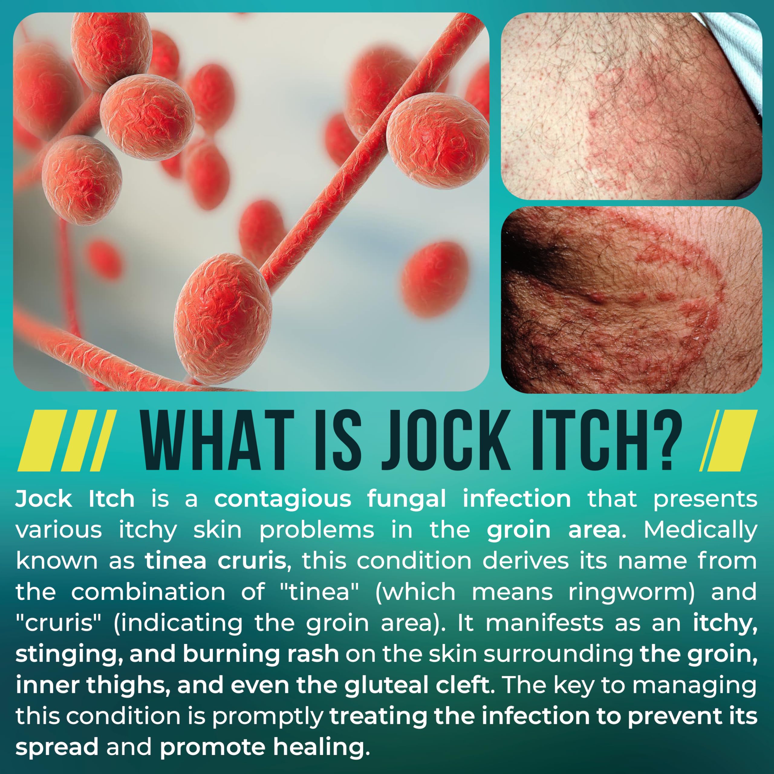 Jock Itch Antifungal Treatment | Extra Strength

