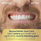 Waterpik Water Flosser for Gum Health

