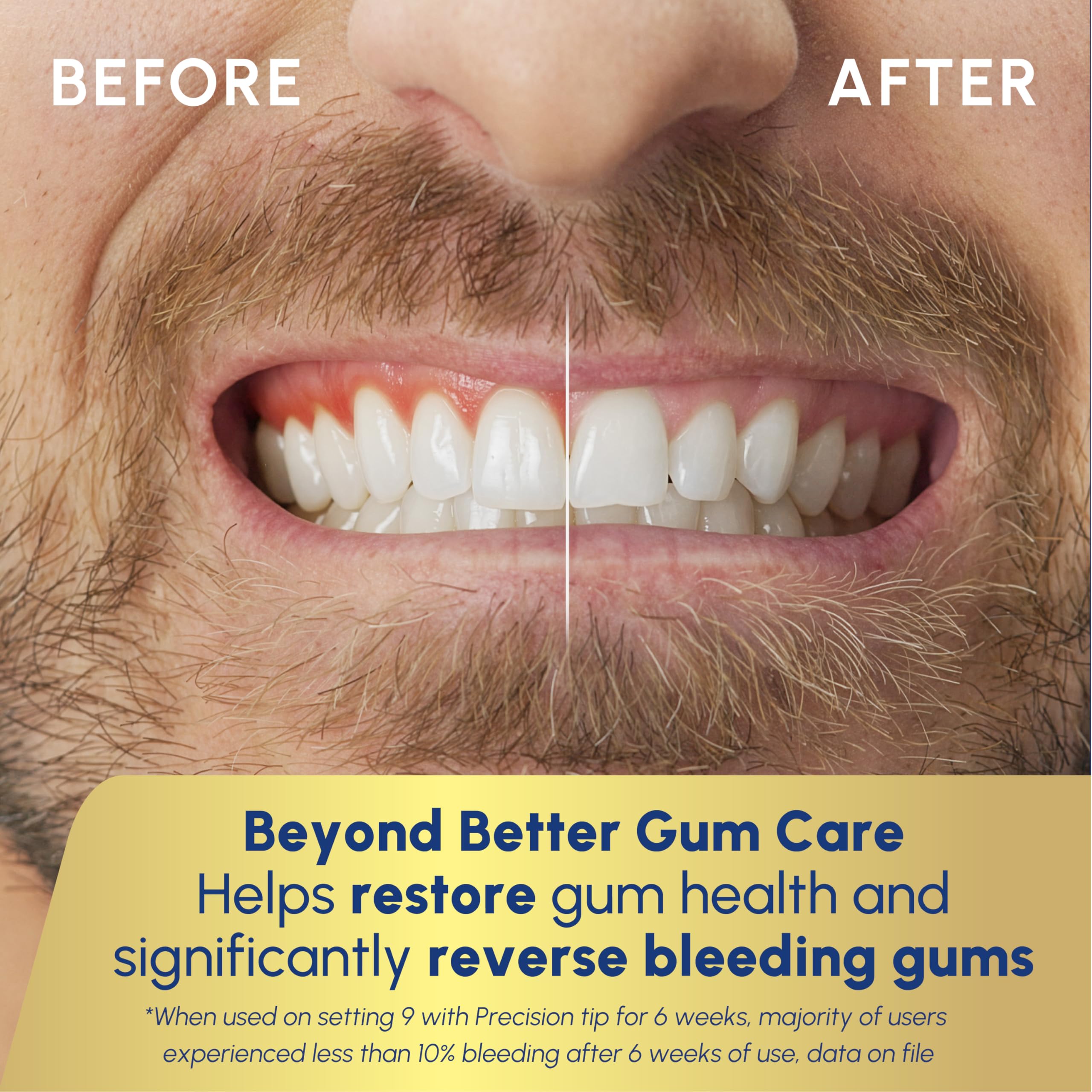 Waterpik Water Flosser for Gum Health

