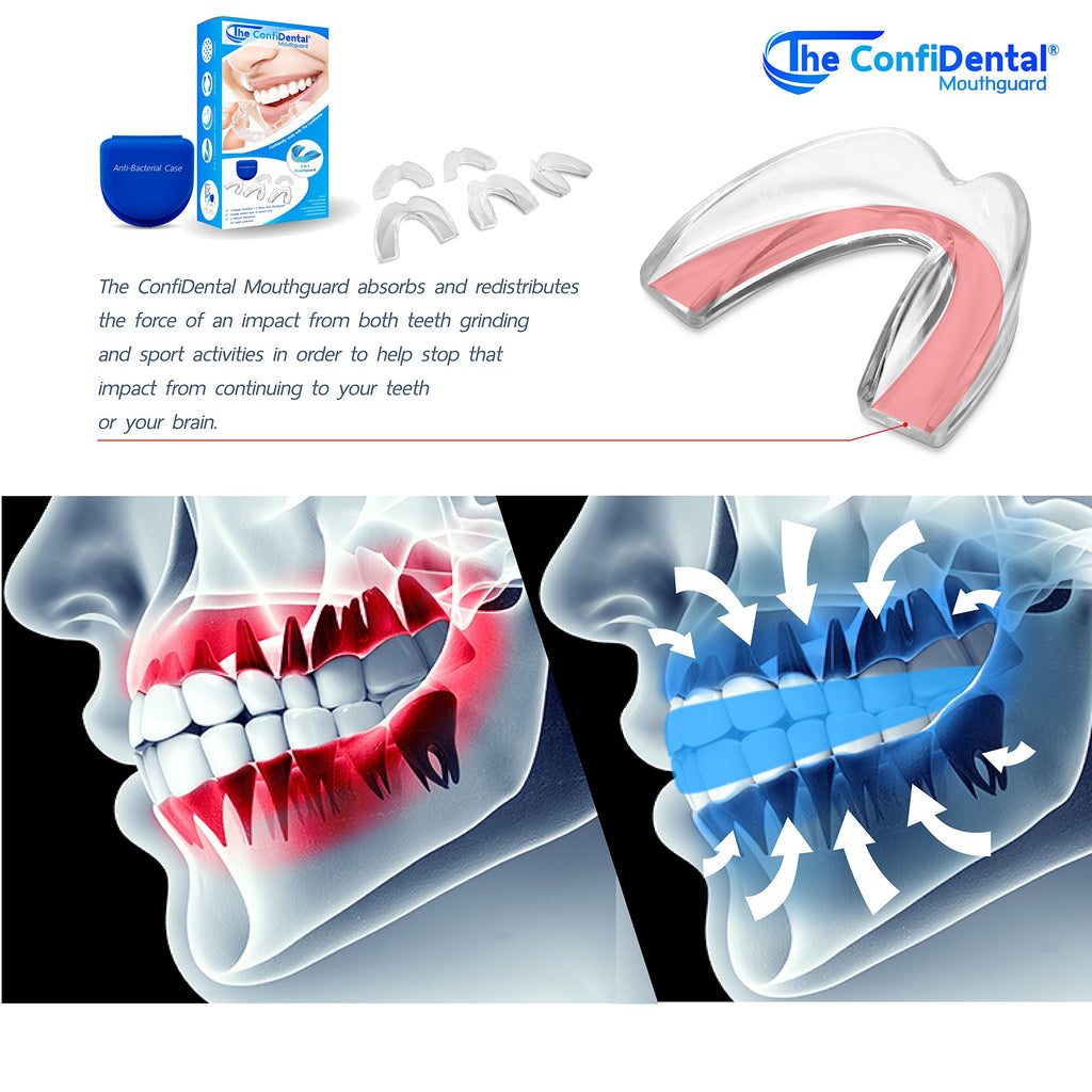 ConfiDental Anti Grinding Guard Moldable Night Mouth Guard

