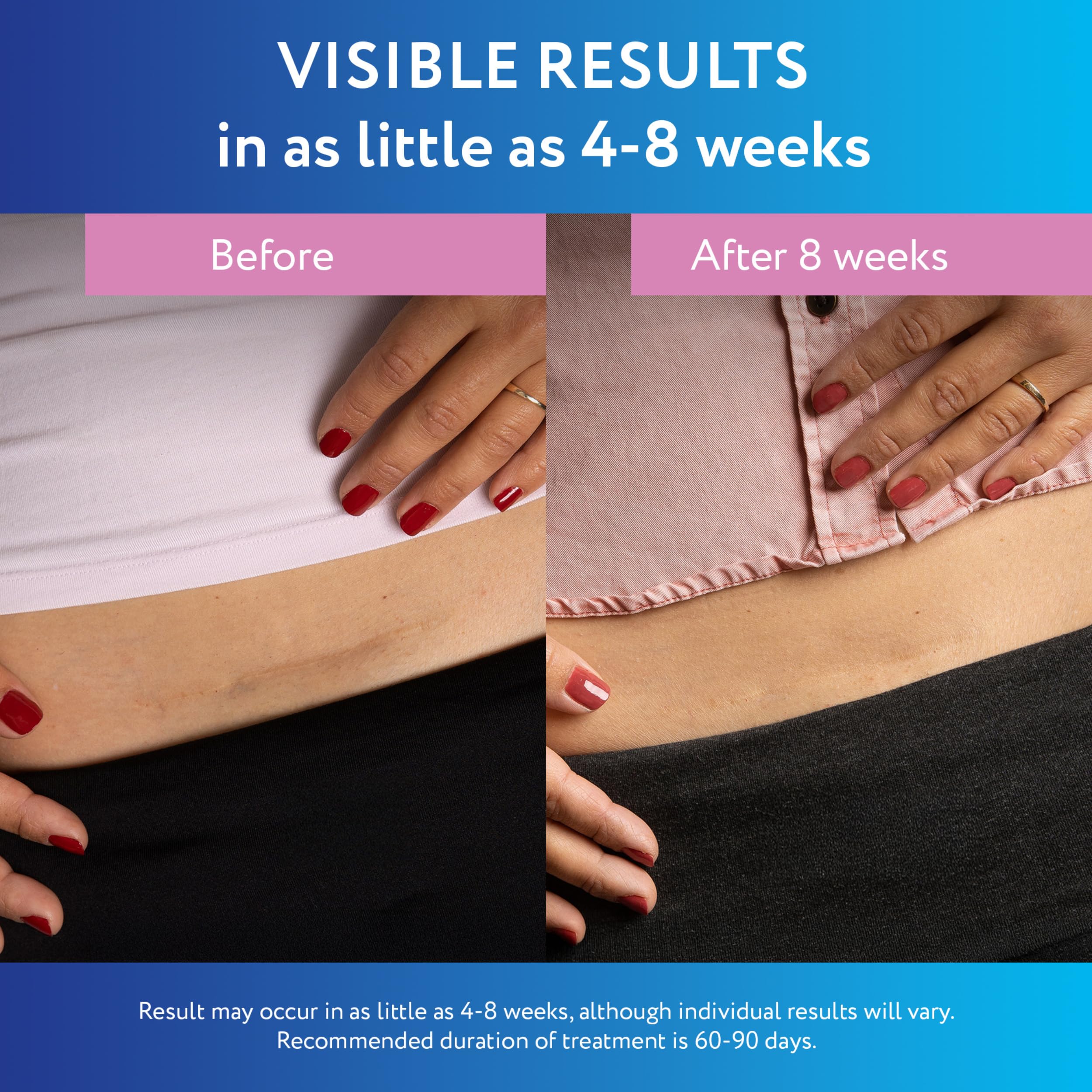 ScarAway Silicone Scar Strips - Advanced for C-Section

